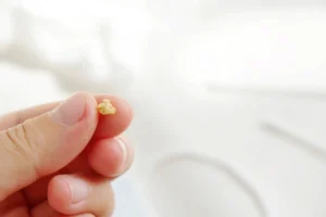 Mi az a mandulakő, és mit tehetünk ellene?